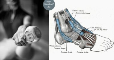 Tendinitis del peroneo